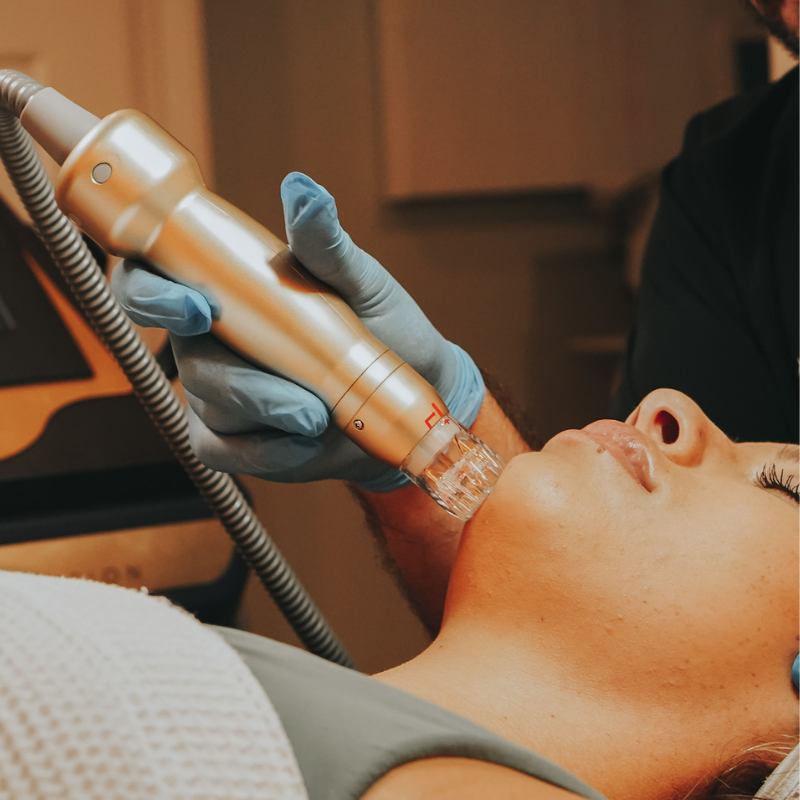 Microneedling Therapy process on face of a women