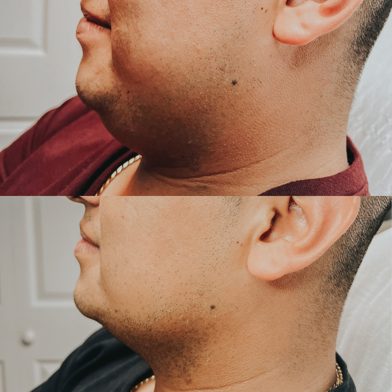 two combinations of same face, before and after treatment