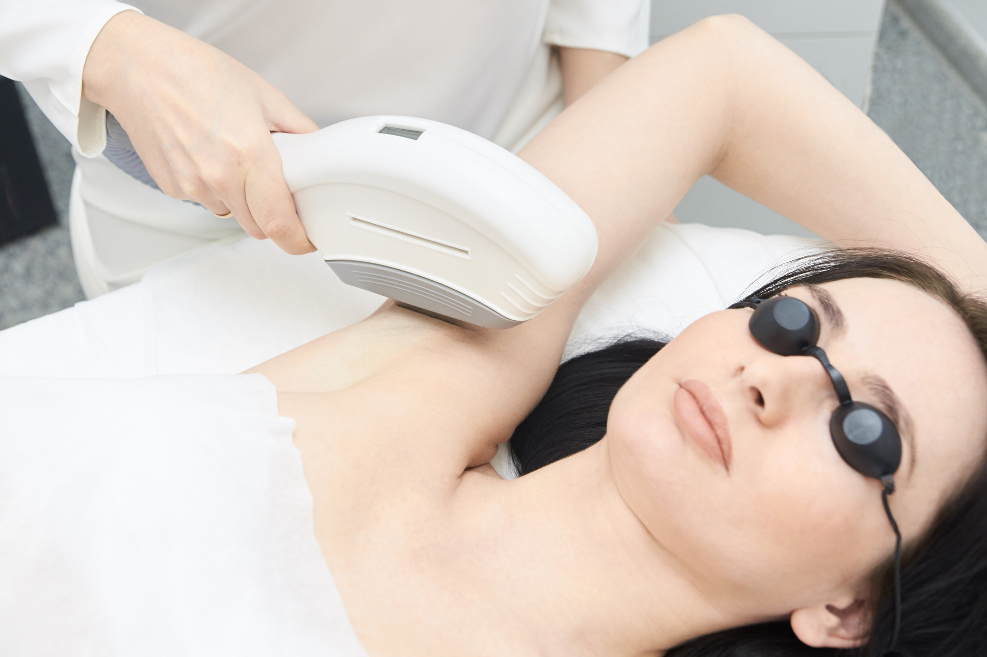 laser hair removal treatment