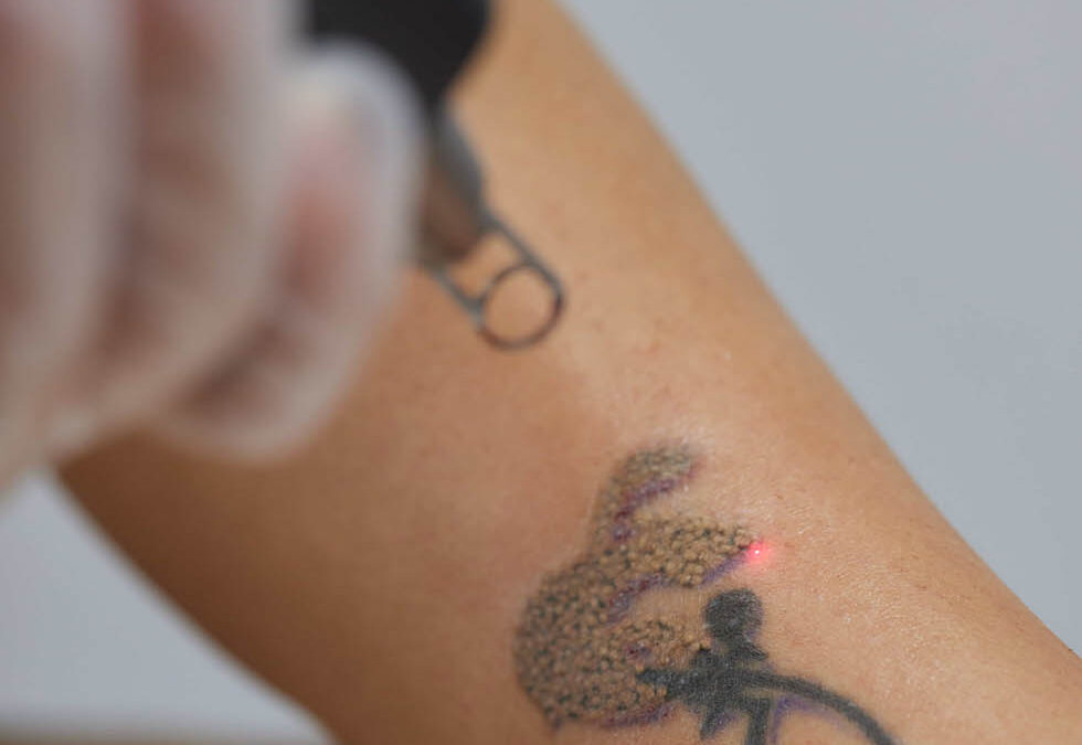 The Tattoo Removal Process: A Guide