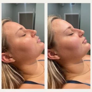 Non-Surgical Nose Jobs: Liquid Rhinoplasty at The Laser Lounge Spa & Salon Sarasota